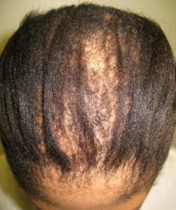 hair loss in black women, advice from afro hair specialists at Junior Green Hair Salon in Kensington, West London